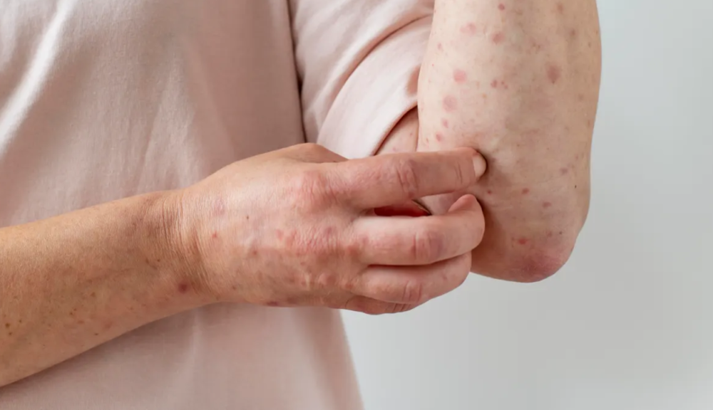 Bolivia recibe 300.000 vacunas contra el sarampión