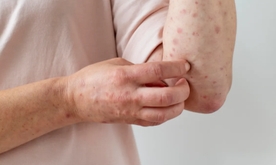 Bolivia recibe 300.000 vacunas contra el sarampión